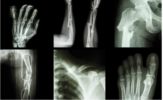 Various x-ray images of fractured bones